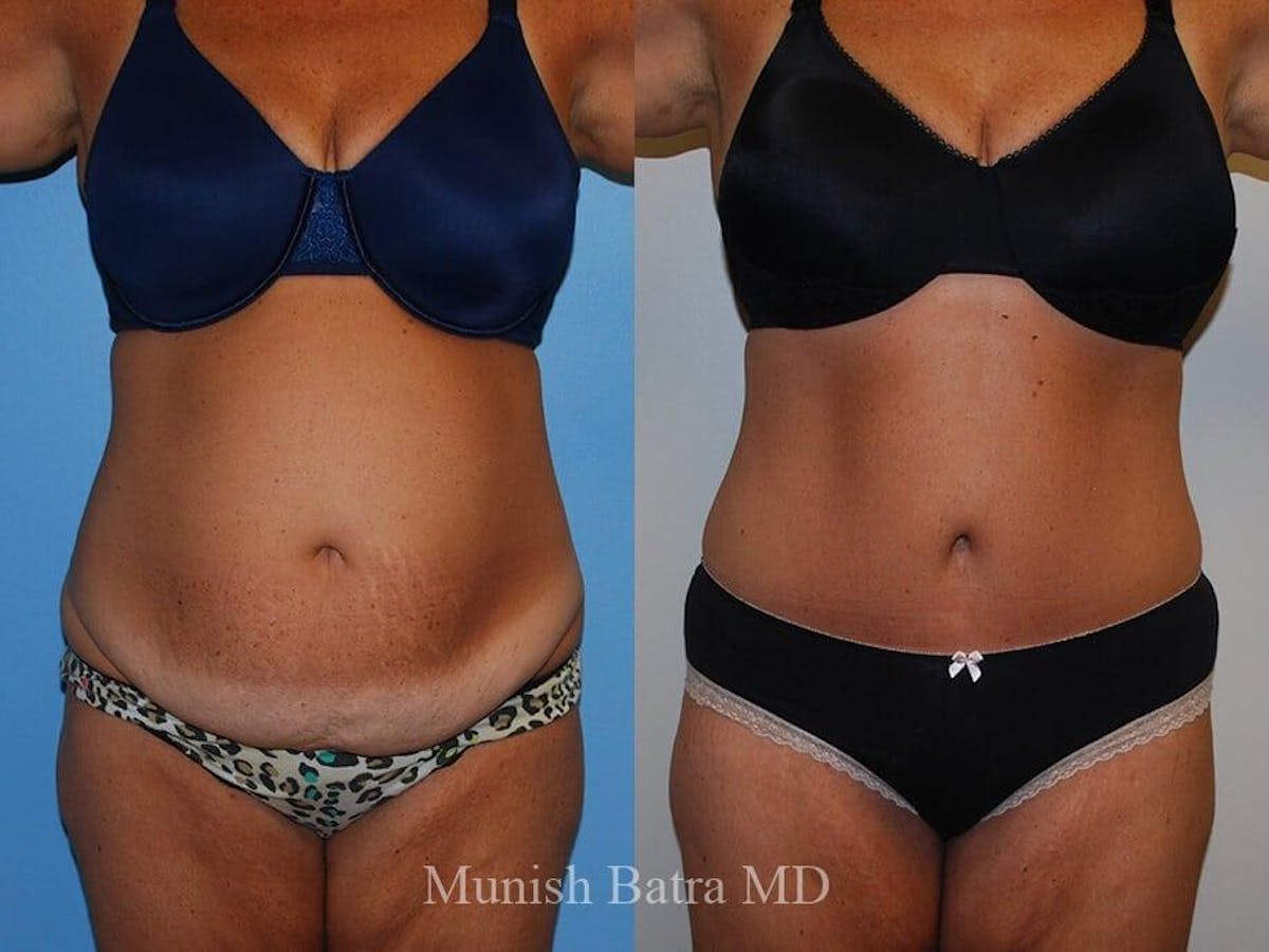 Tummy Tuck Before & After Gallery - Patient 237429 - Image 1