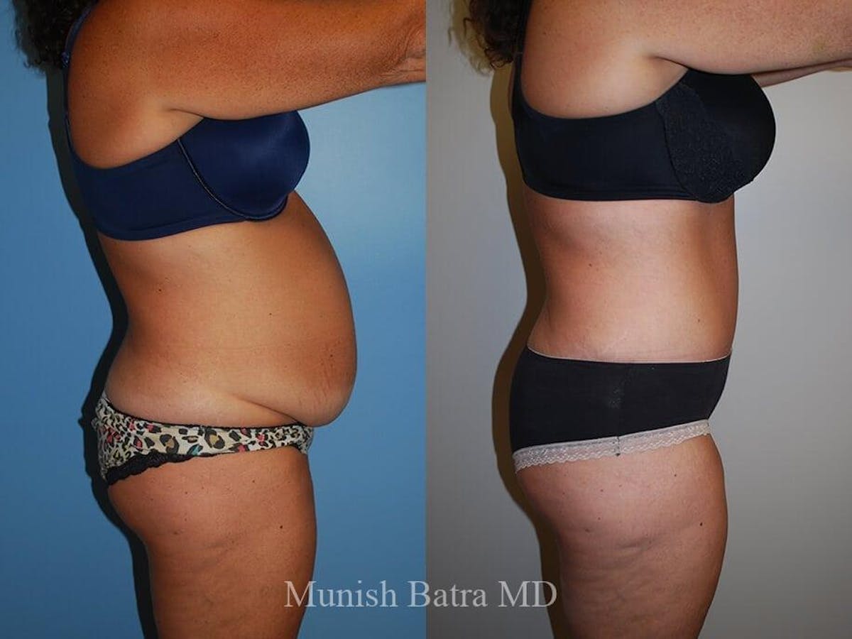 Tummy Tuck Before & After Gallery - Patient 237429 - Image 2