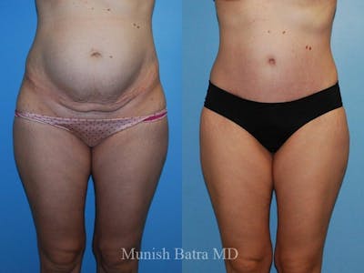 Tummy Tuck Before & After Gallery - Patient 274716 - Image 1