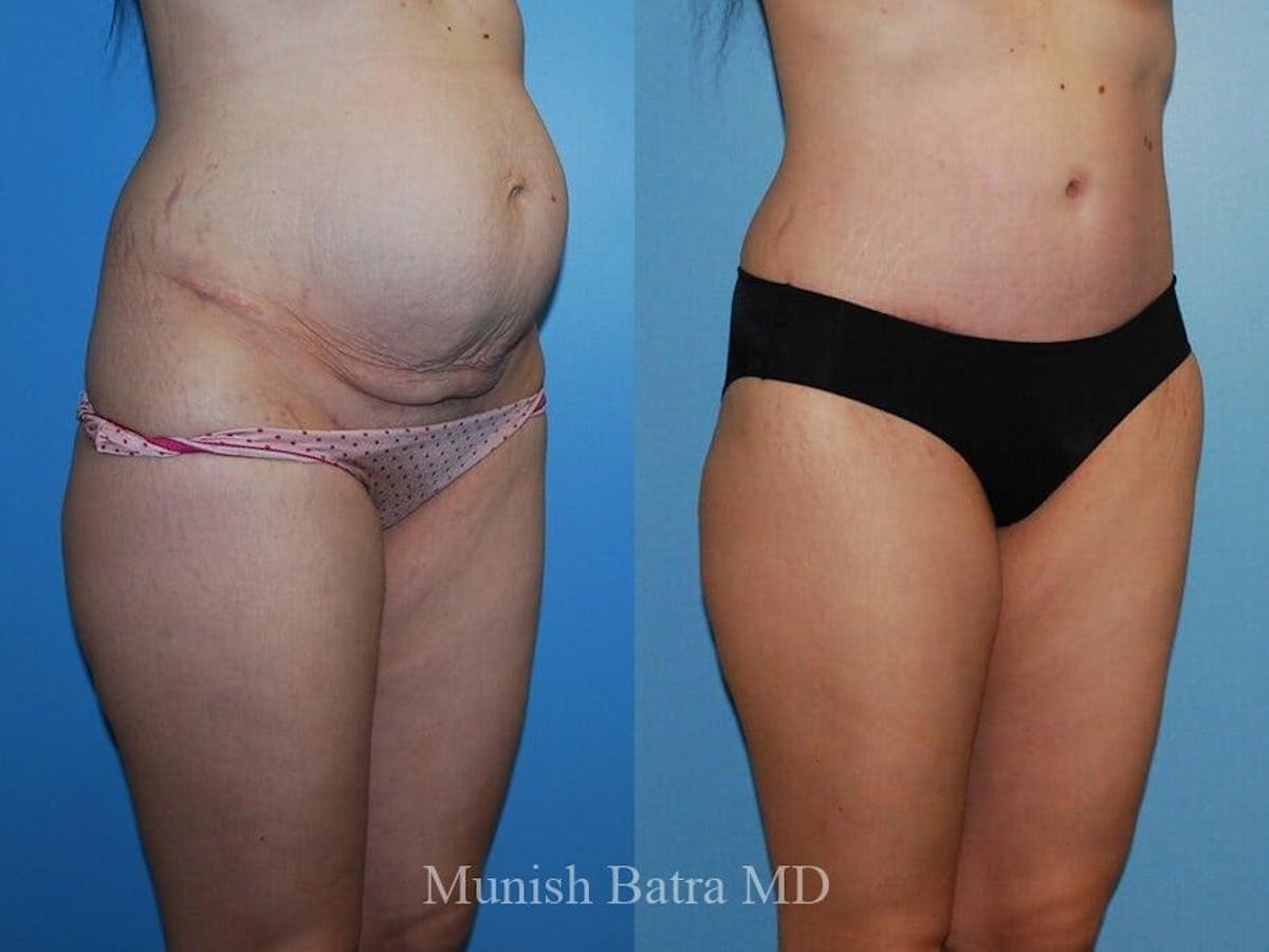 Tummy Tuck Before & After Gallery - Patient 274716 - Image 2