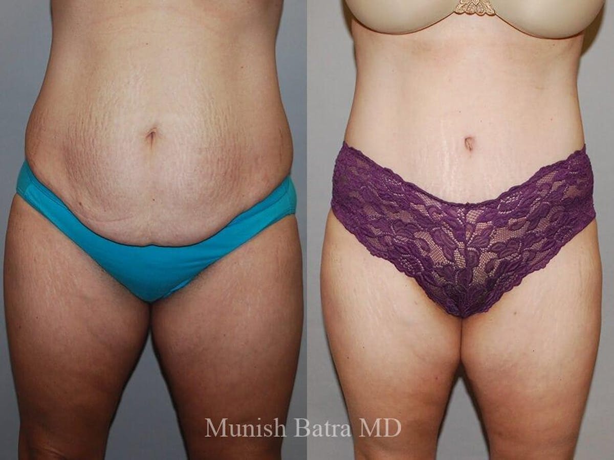 Tummy Tuck Before & After Gallery - Patient 383401 - Image 1