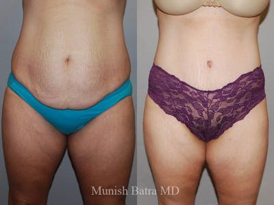 Tummy Tuck Before & After Gallery - Patient 383401 - Image 1