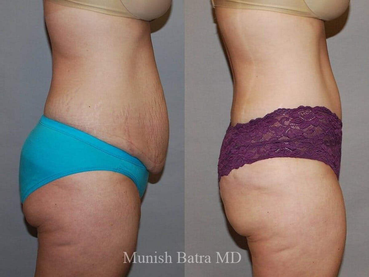Tummy Tuck Before & After Gallery - Patient 383401 - Image 2