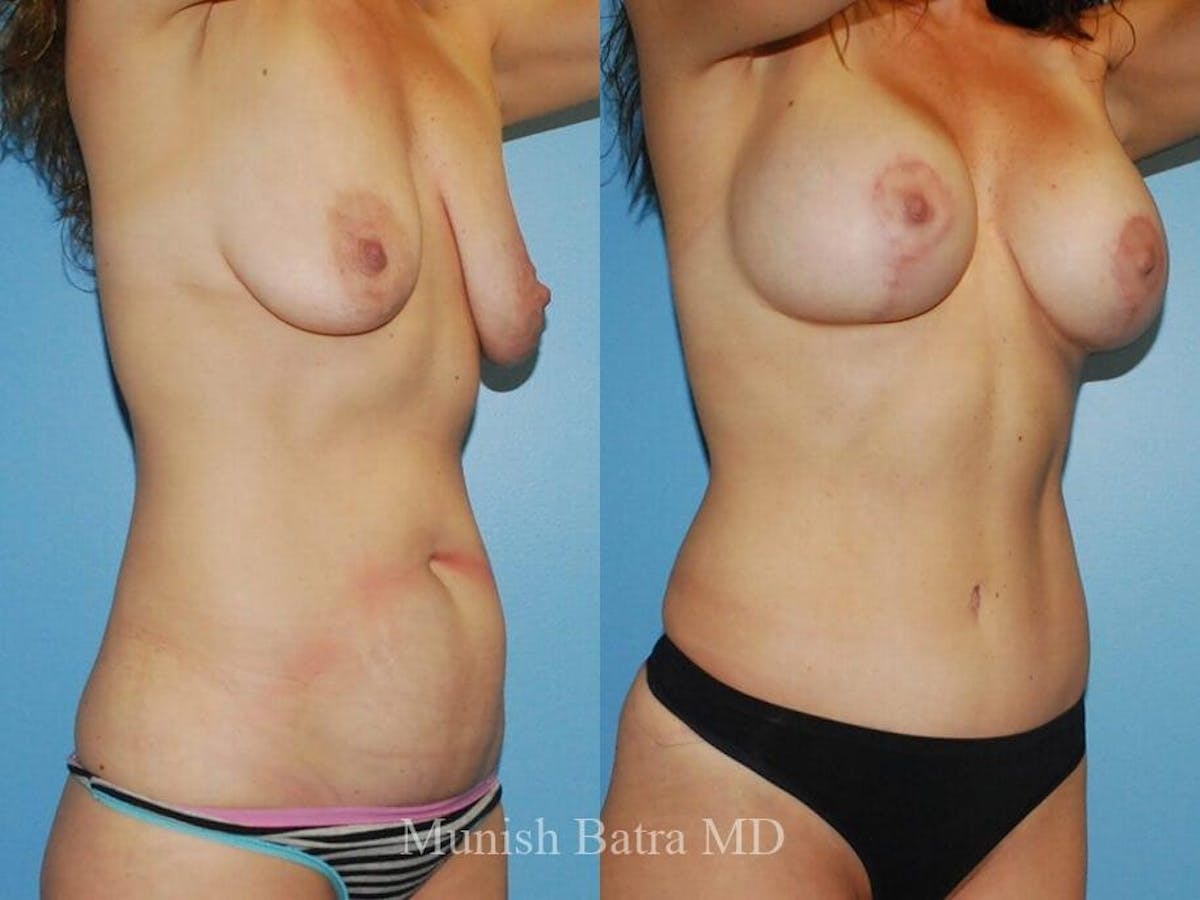 Tummy Tuck Before & After Gallery - Patient 392560 - Image 1