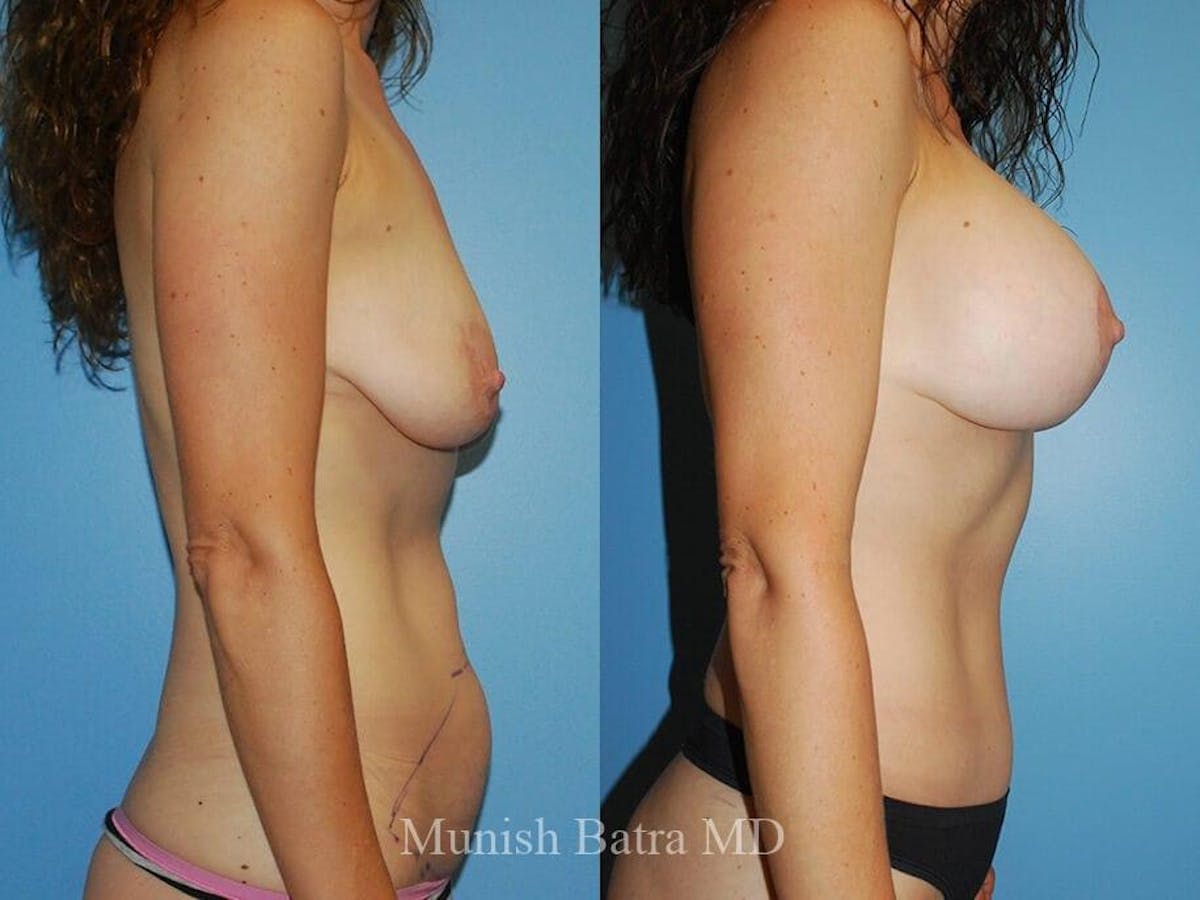 Tummy Tuck Before & After Gallery - Patient 392560 - Image 2