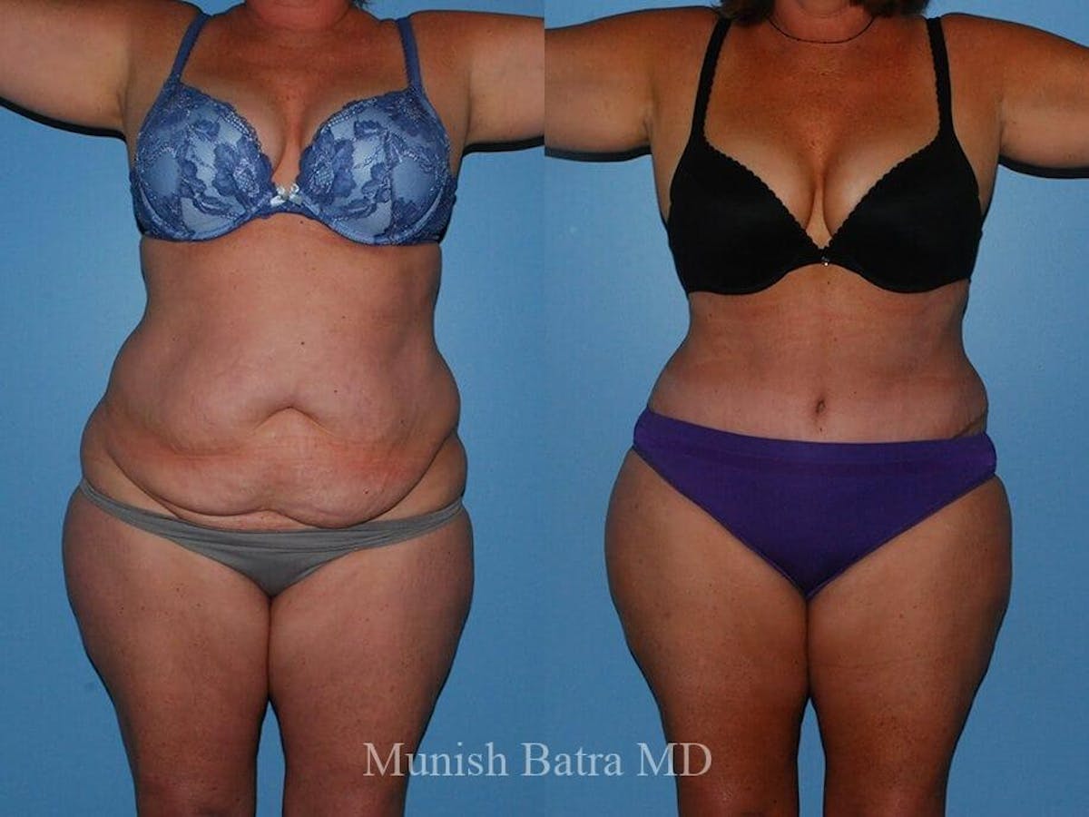 Tummy Tuck Before & After Gallery - Patient 243942 - Image 1