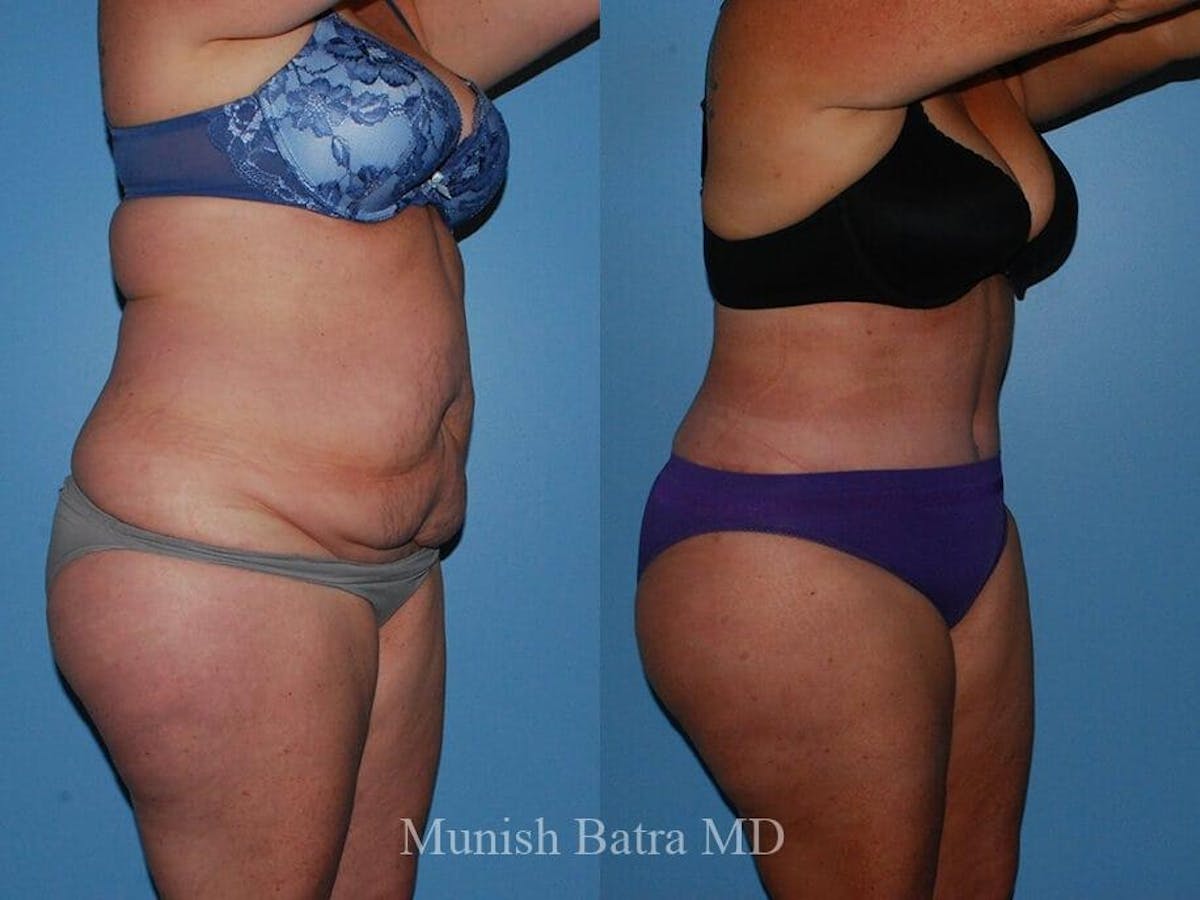Tummy Tuck Before & After Gallery - Patient 243942 - Image 2