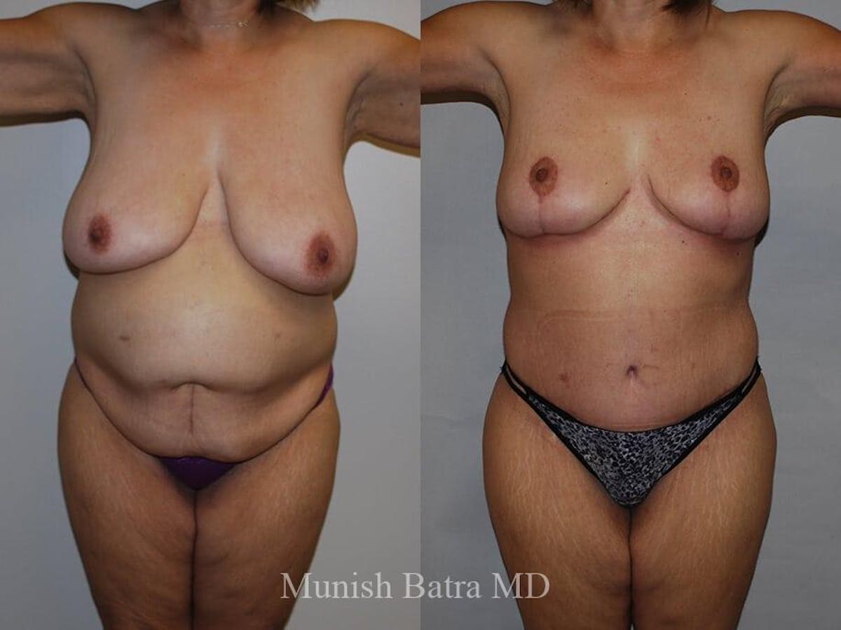 Tummy Tuck Before & After Gallery - Patient 137619 - Image 1