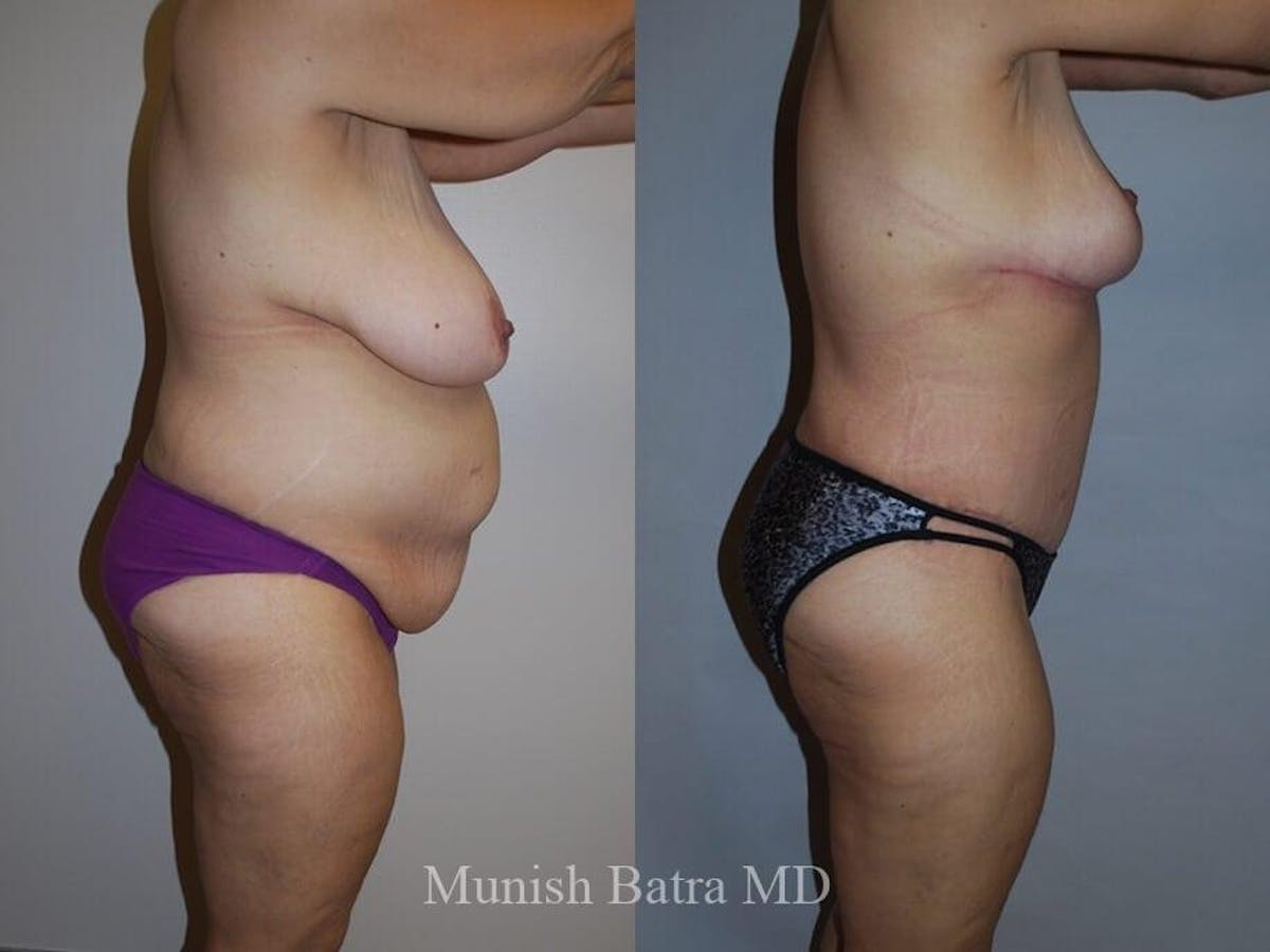 Tummy Tuck Before & After Gallery - Patient 137619 - Image 2
