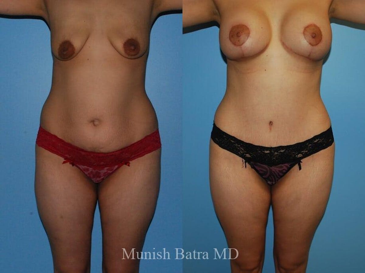Tummy Tuck Before & After Gallery - Patient 225109 - Image 1