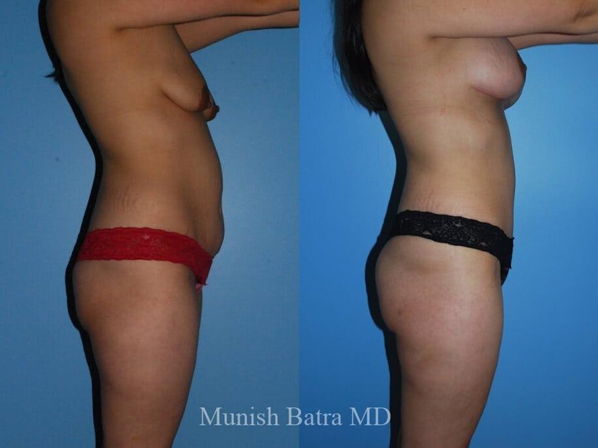 Tummy Tuck Before & After Gallery - Patient 225109 - Image 2