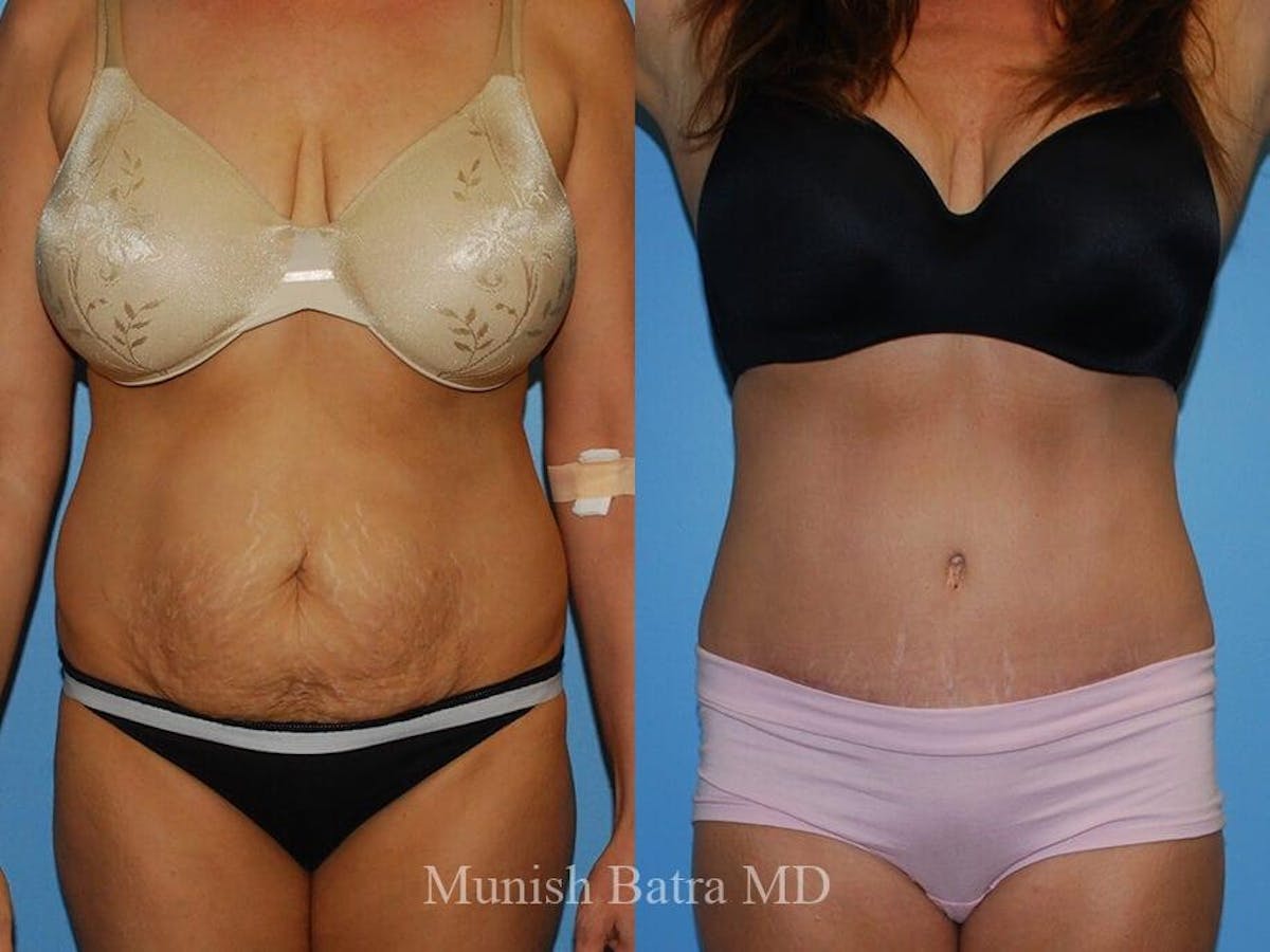 Tummy Tuck Before & After Gallery - Patient 318634 - Image 1