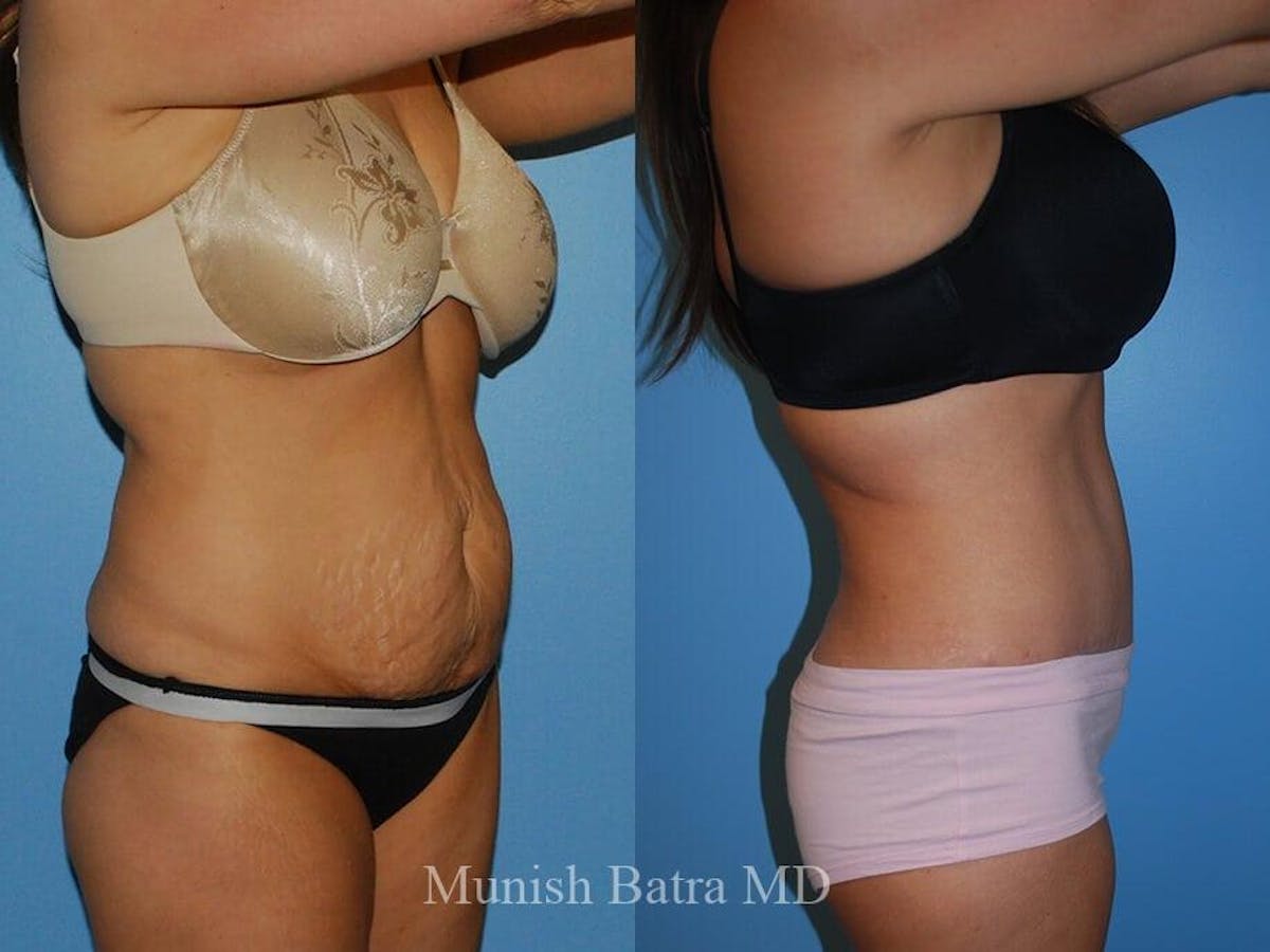 Tummy Tuck Before & After Gallery - Patient 318634 - Image 2