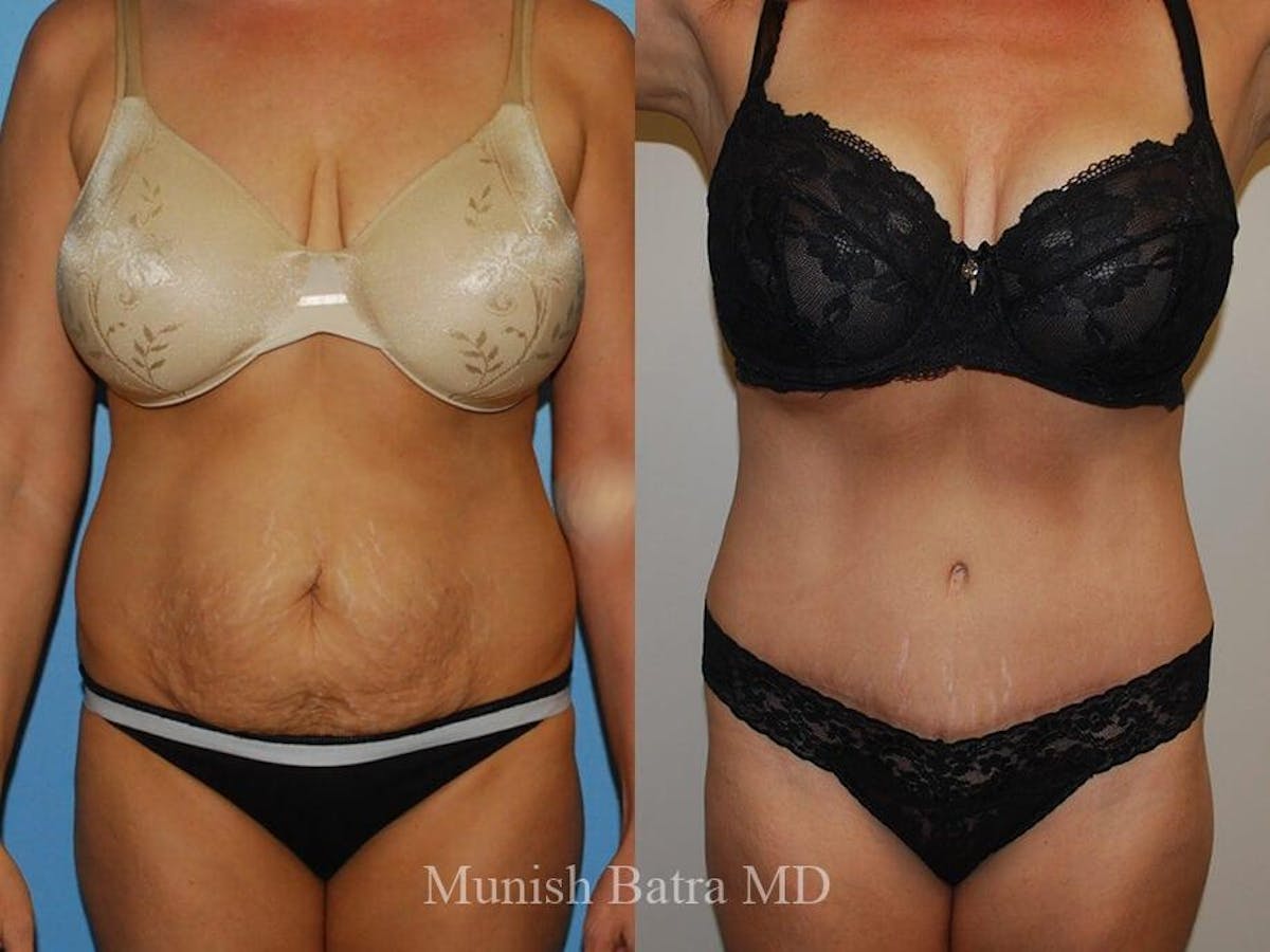 Tummy Tuck Before & After Gallery - Patient 372097 - Image 1