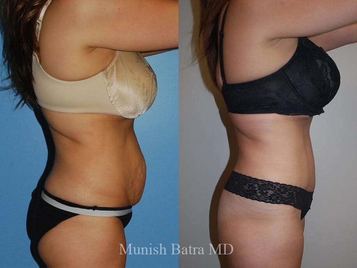 Tummy Tuck Before & After Gallery - Patient 372097 - Image 2