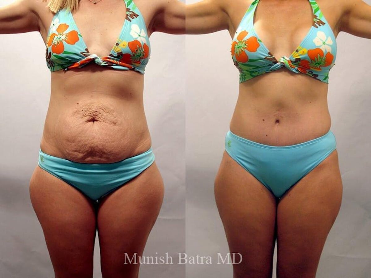 Tummy Tuck Before & After Gallery - Patient 169490 - Image 1