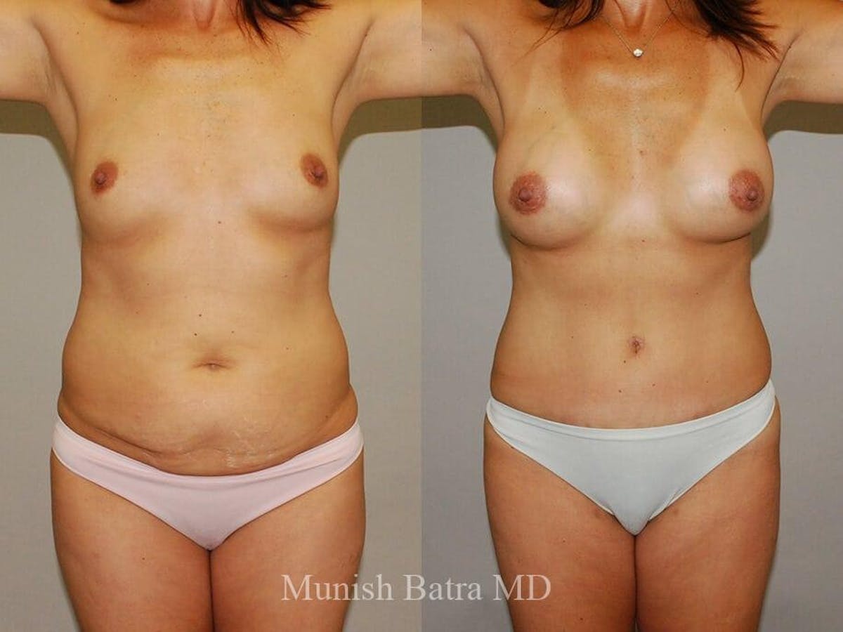 Tummy Tuck Before & After Gallery - Patient 218693 - Image 1