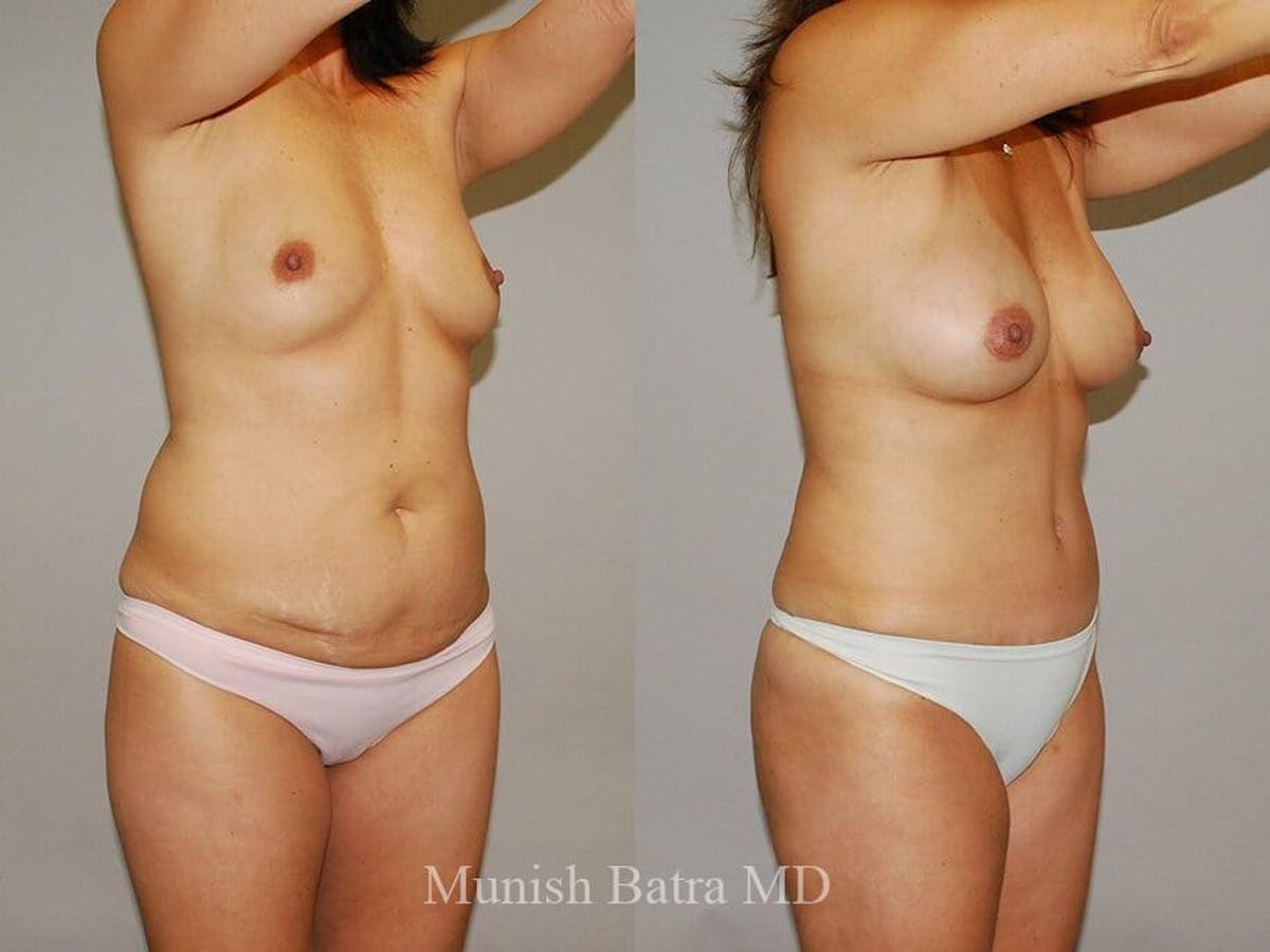 Tummy Tuck Before & After Gallery - Patient 218693 - Image 2