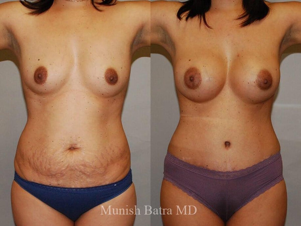 Tummy Tuck Before & After Gallery - Patient 521071 - Image 1