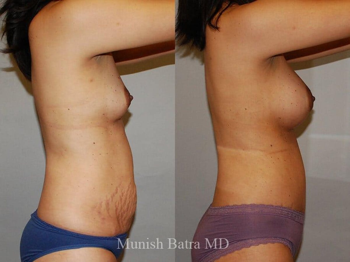 Tummy Tuck Before & After Gallery - Patient 521071 - Image 2