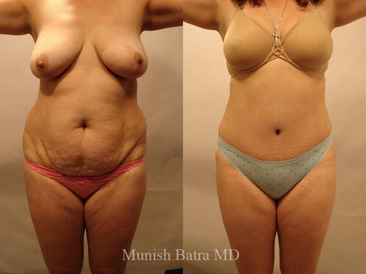 Tummy Tuck Before & After Gallery - Patient 173275 - Image 1