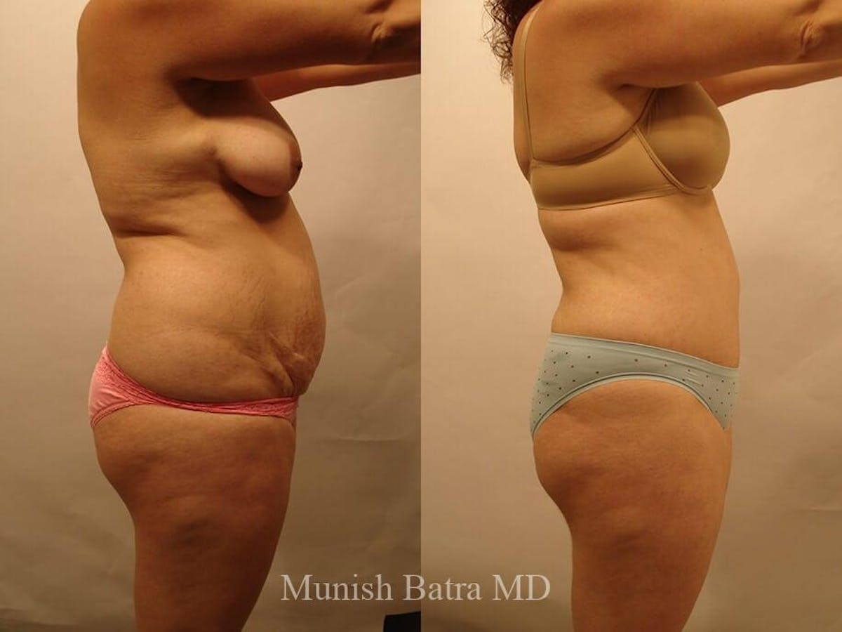 Tummy Tuck Before & After Gallery - Patient 173275 - Image 2