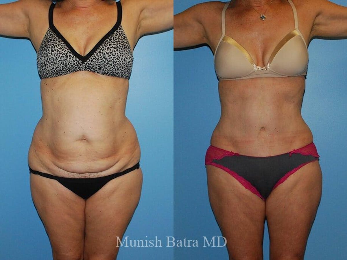 Tummy Tuck Before & After Gallery - Patient 351625 - Image 1