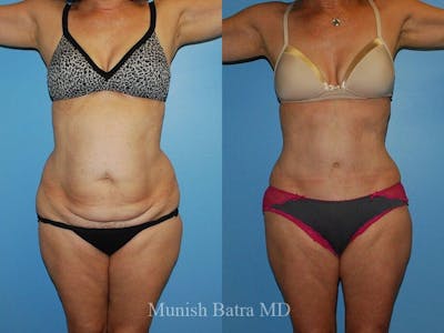 Tummy Tuck Before & After Gallery - Patient 351625 - Image 1
