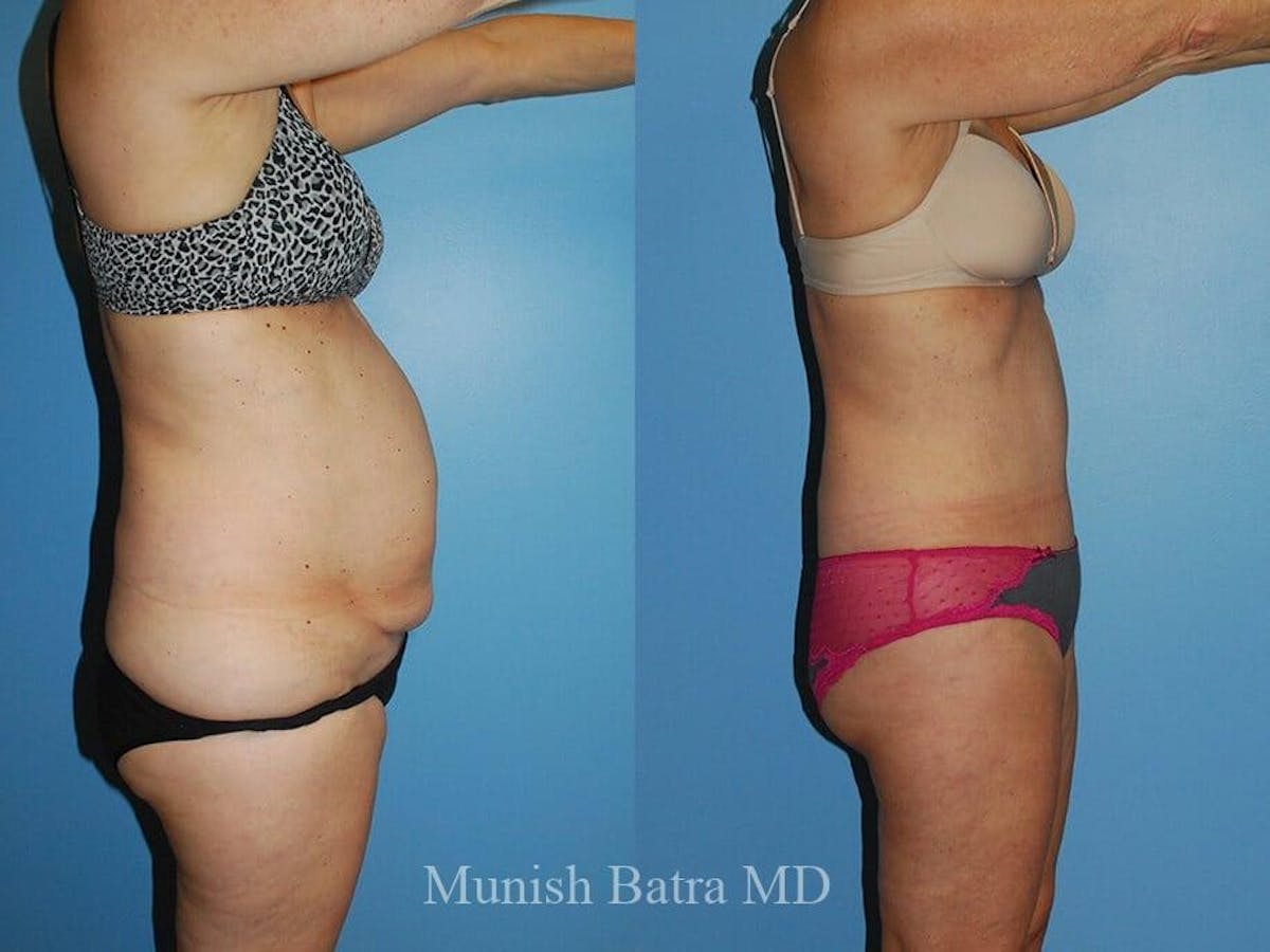 Tummy Tuck Before & After Gallery - Patient 351625 - Image 2