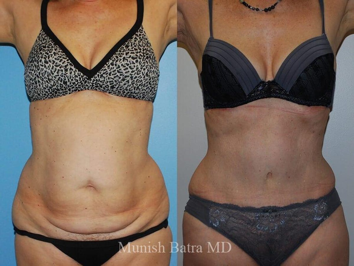 Tummy Tuck Before & After Gallery - Patient 425560 - Image 1