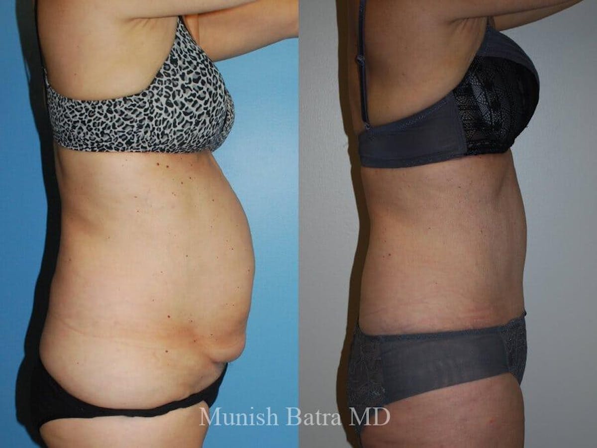 Tummy Tuck Before & After Gallery - Patient 425560 - Image 2