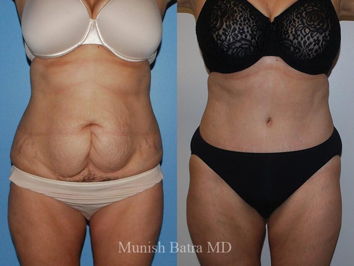 Tummy Tuck Before & After Gallery - Patient 108642 - Image 1