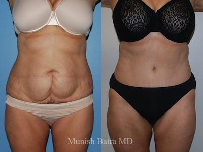 Tummy Tuck Before & After Gallery - Patient 108642 - Image 1