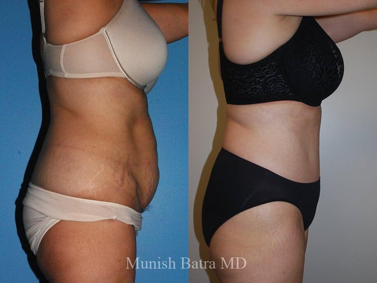 Tummy Tuck Before & After Gallery - Patient 108642 - Image 2