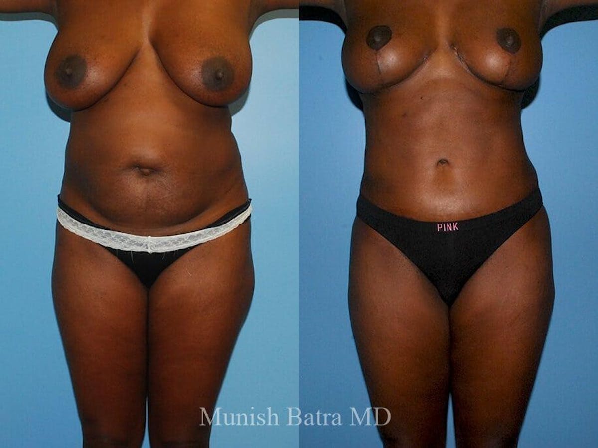 Tummy Tuck Before & After Gallery - Patient 391574 - Image 1