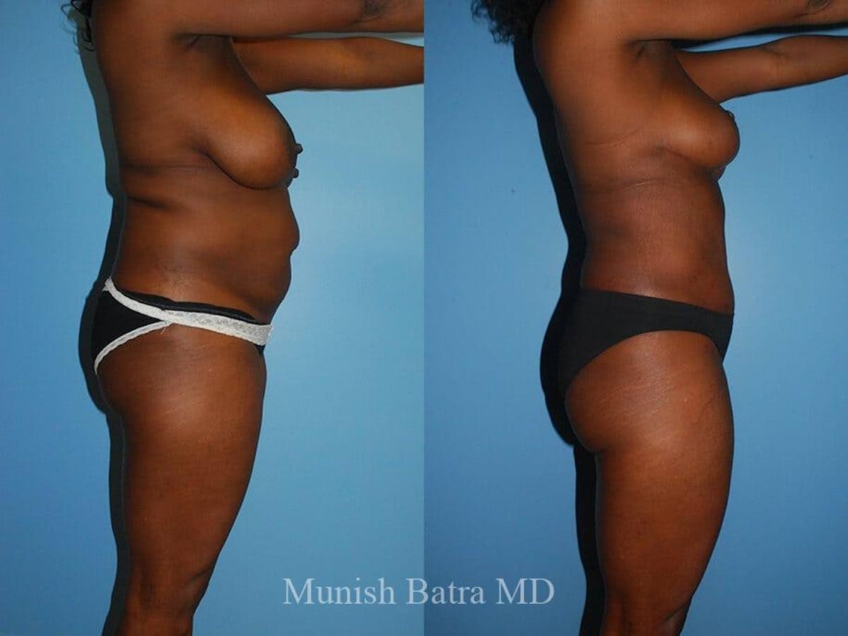 Tummy Tuck Before & After Gallery - Patient 391574 - Image 2