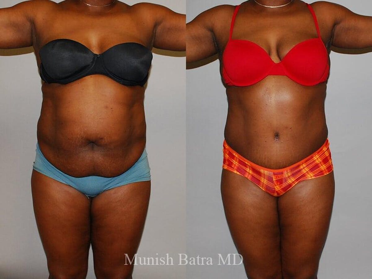 Tummy Tuck Before & After Gallery - Patient 385487 - Image 1