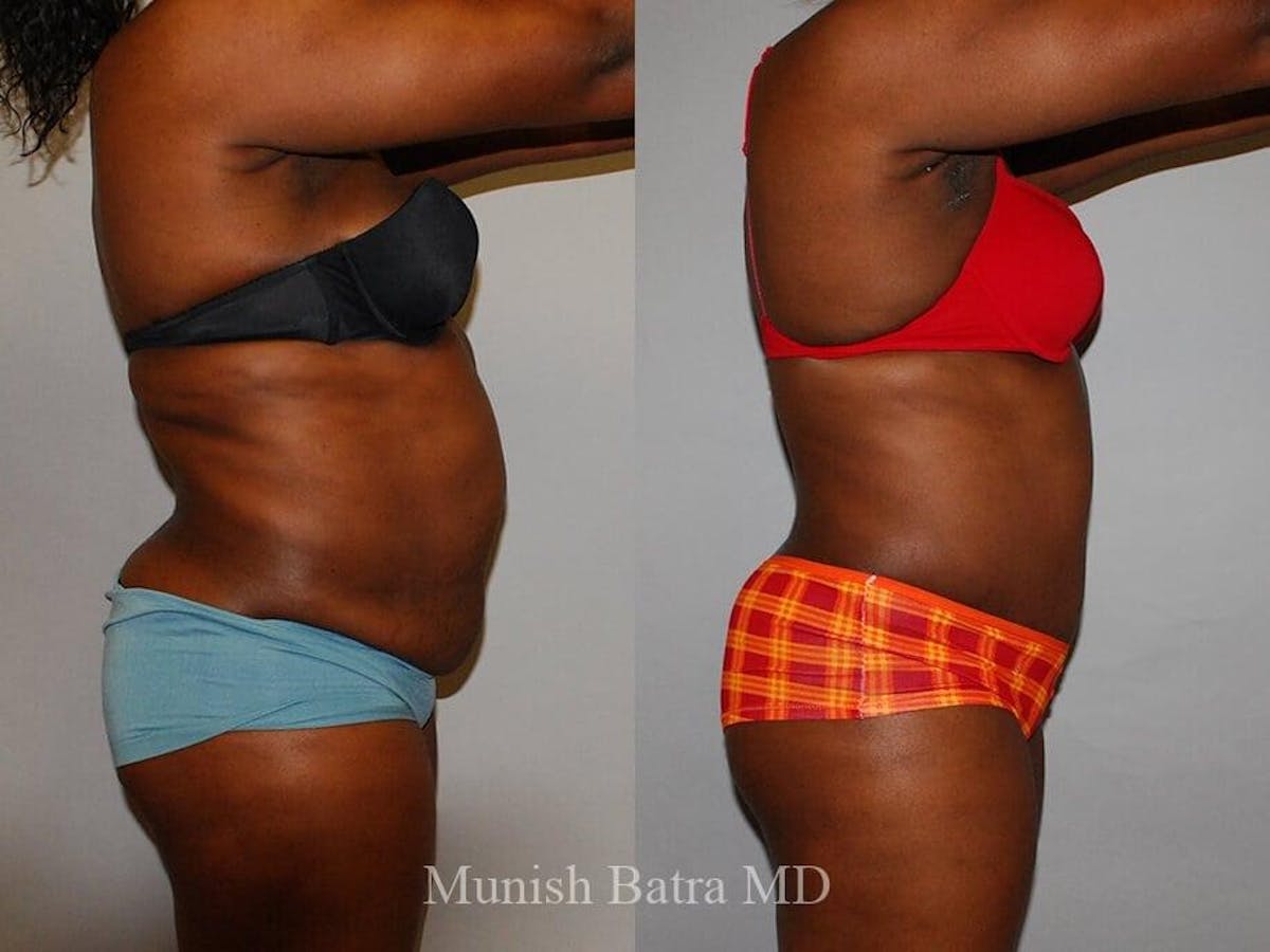 Tummy Tuck Before & After Gallery - Patient 385487 - Image 2
