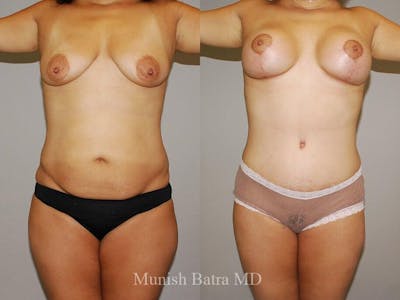 Tummy Tuck Before & After Gallery - Patient 169610 - Image 1