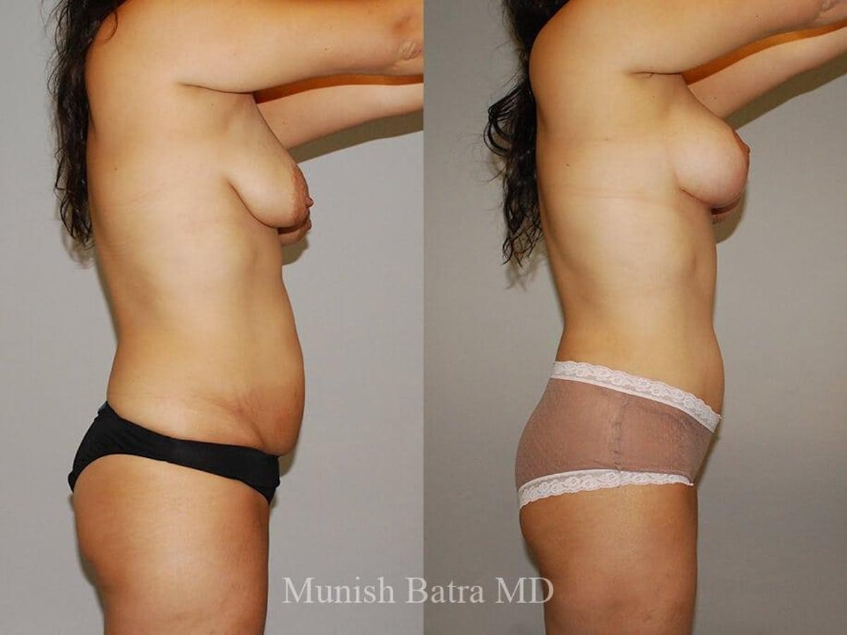 Tummy Tuck Before & After Gallery - Patient 169610 - Image 2