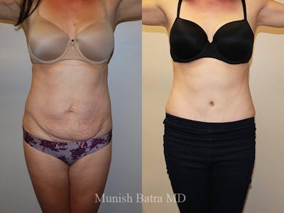 Tummy Tuck Before & After Gallery - Patient 396597 - Image 1