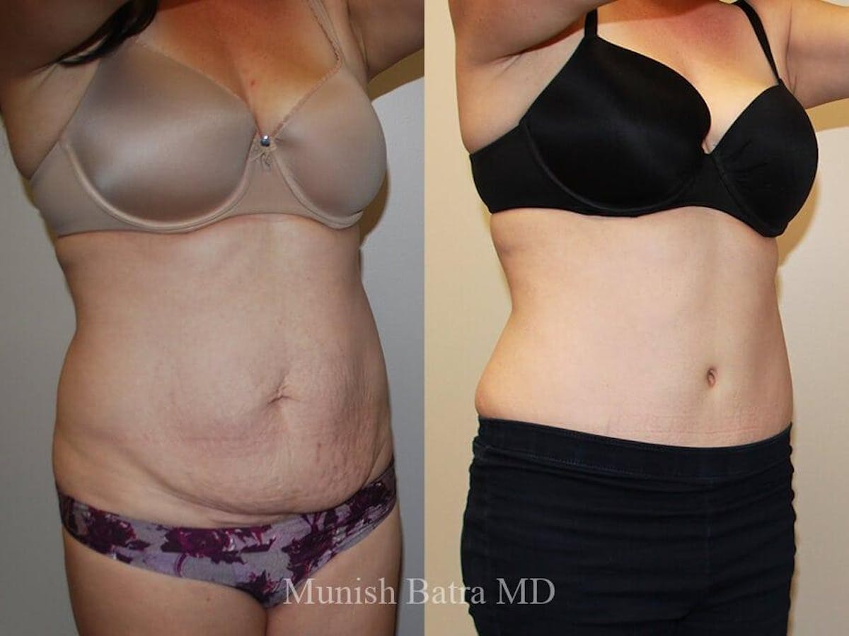 Tummy Tuck Before & After Gallery - Patient 396597 - Image 2