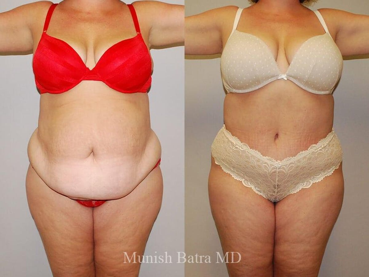 Tummy Tuck Before & After Gallery - Patient 241866 - Image 1