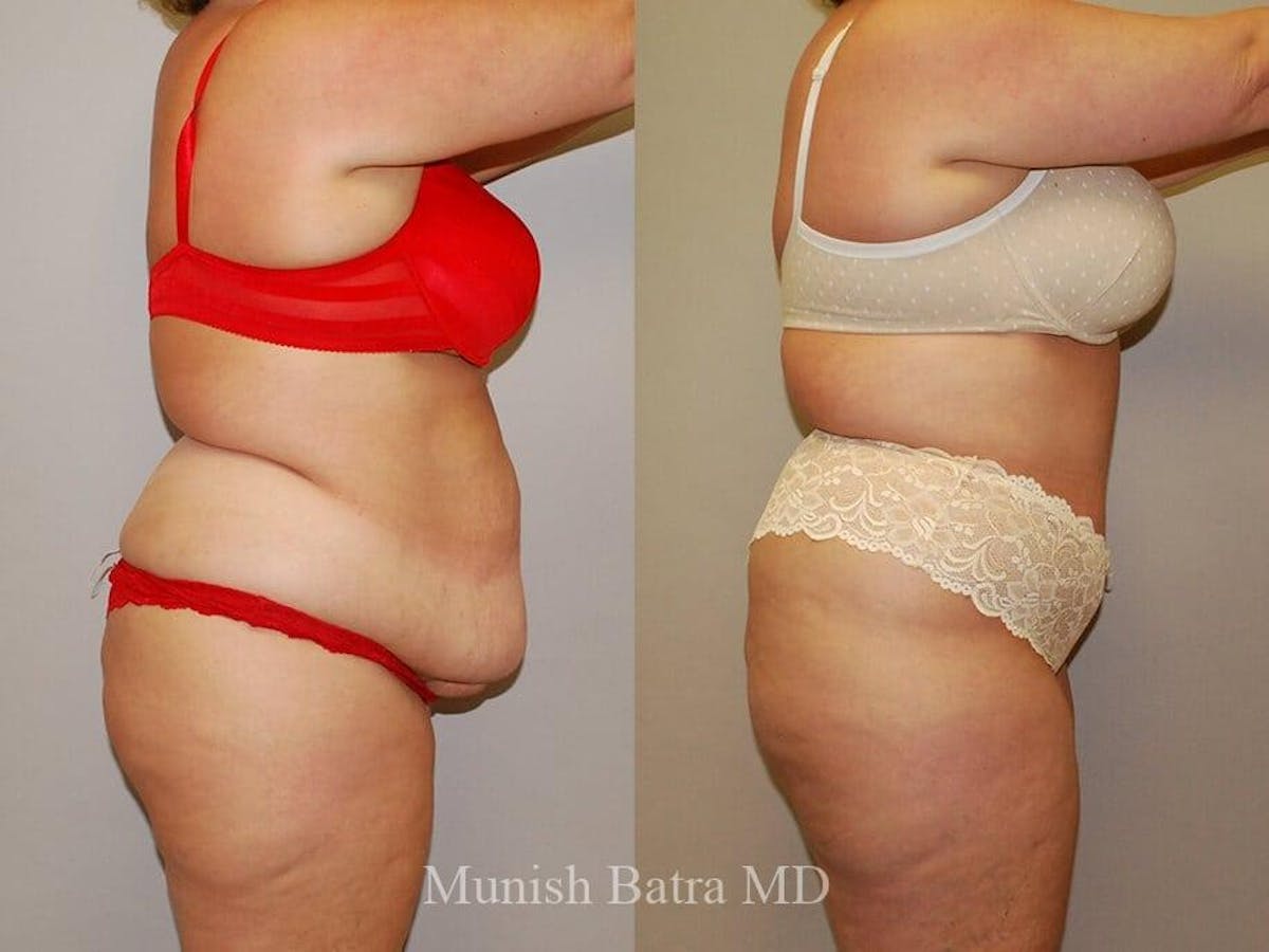 Tummy Tuck Before & After Gallery - Patient 241866 - Image 2