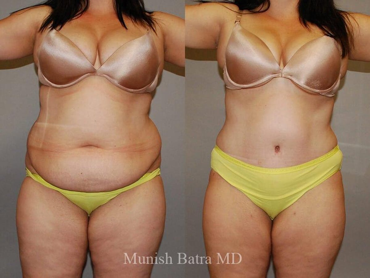 Tummy Tuck Before & After Gallery - Patient 256987 - Image 1