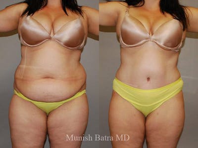 Tummy Tuck Before & After Gallery - Patient 256987 - Image 1