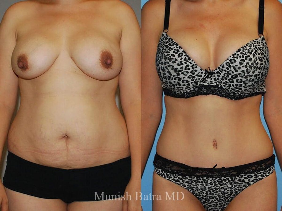 Tummy Tuck Before & After Gallery - Patient 625125 - Image 1