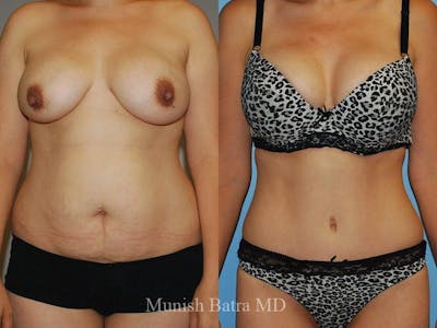 Tummy Tuck Before & After Gallery - Patient 625125 - Image 1