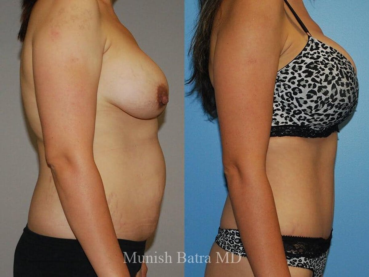 Tummy Tuck Before & After Gallery - Patient 625125 - Image 2