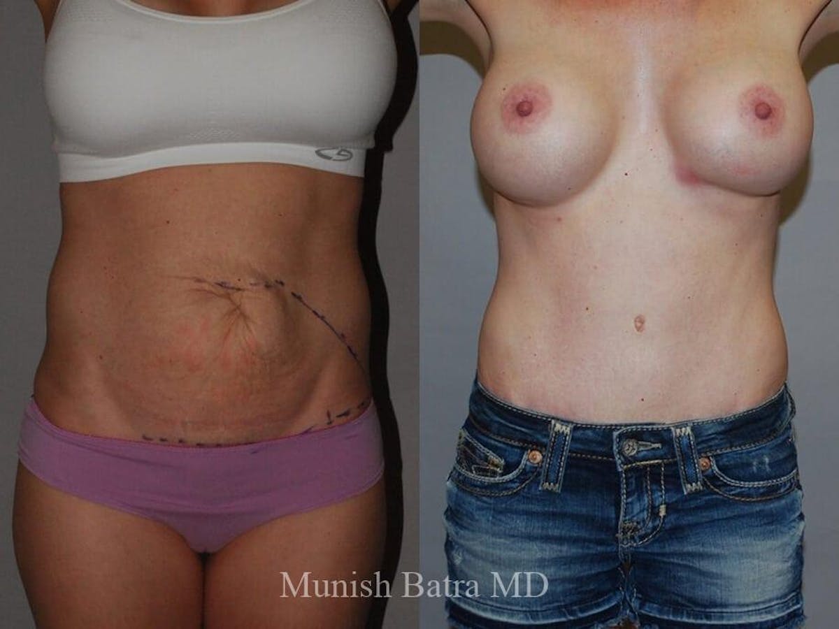 Tummy Tuck Before & After Gallery - Patient 121405 - Image 1